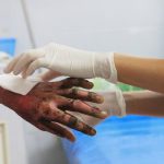What to do in case of burns?