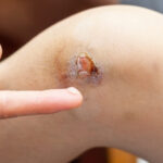 How to treat a graze!
