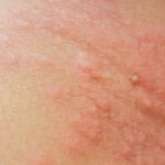 Processionary caterpillar rash? This is what you need to do!